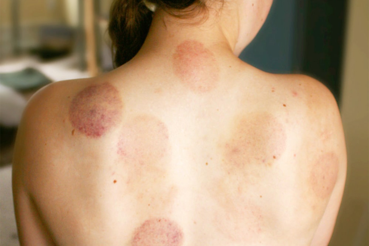 blog_cupping_1200px