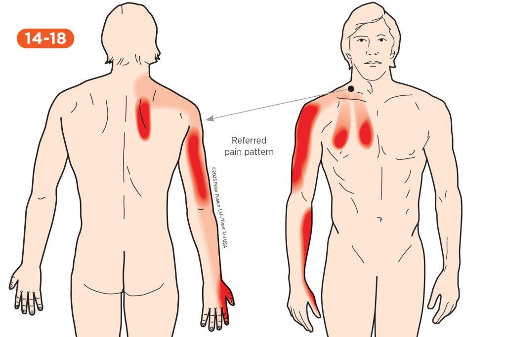 Back Pain 14-18 Scaleni
