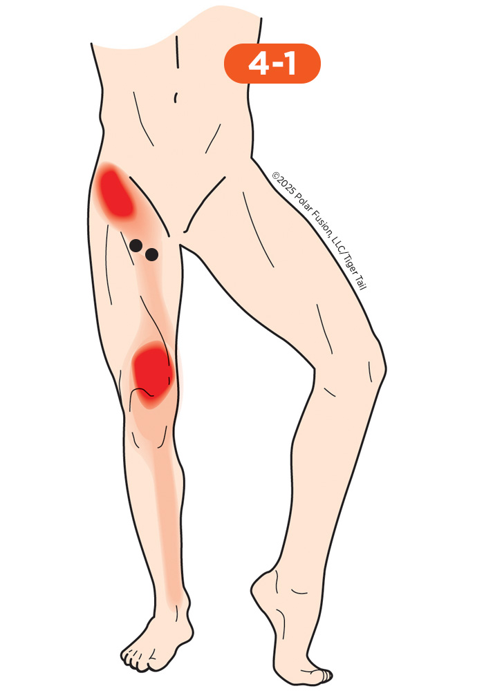 Hip Flexor Pain 4-1 Adductor Brevis Adductor Longus