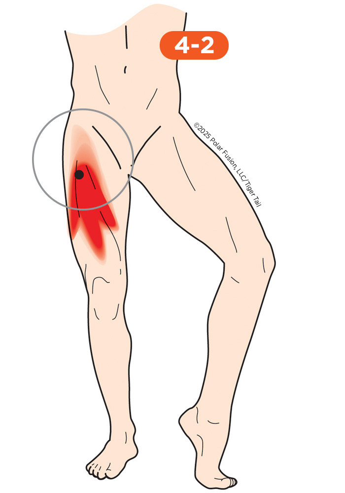 Hip Flexor Pain 4-2 Vastus Intermedius