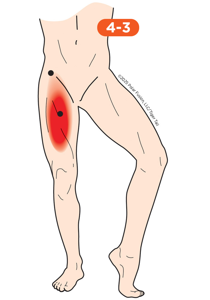 Hip Flexor Pain 4-3 Iliopsoas
