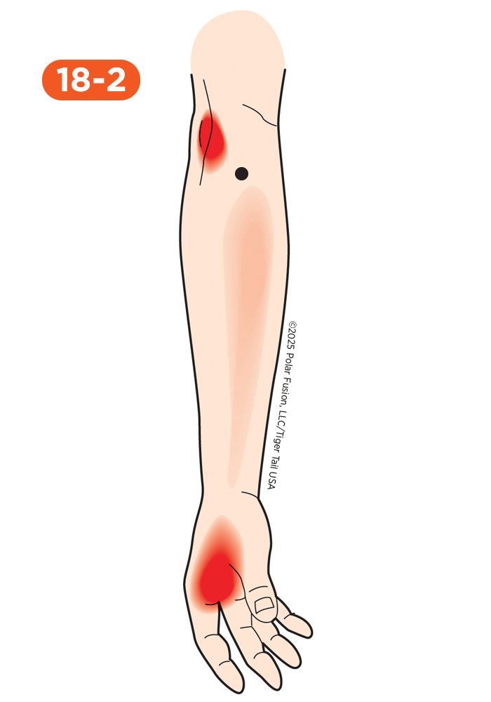 Elbow Pain 18-2 Brachioradialis