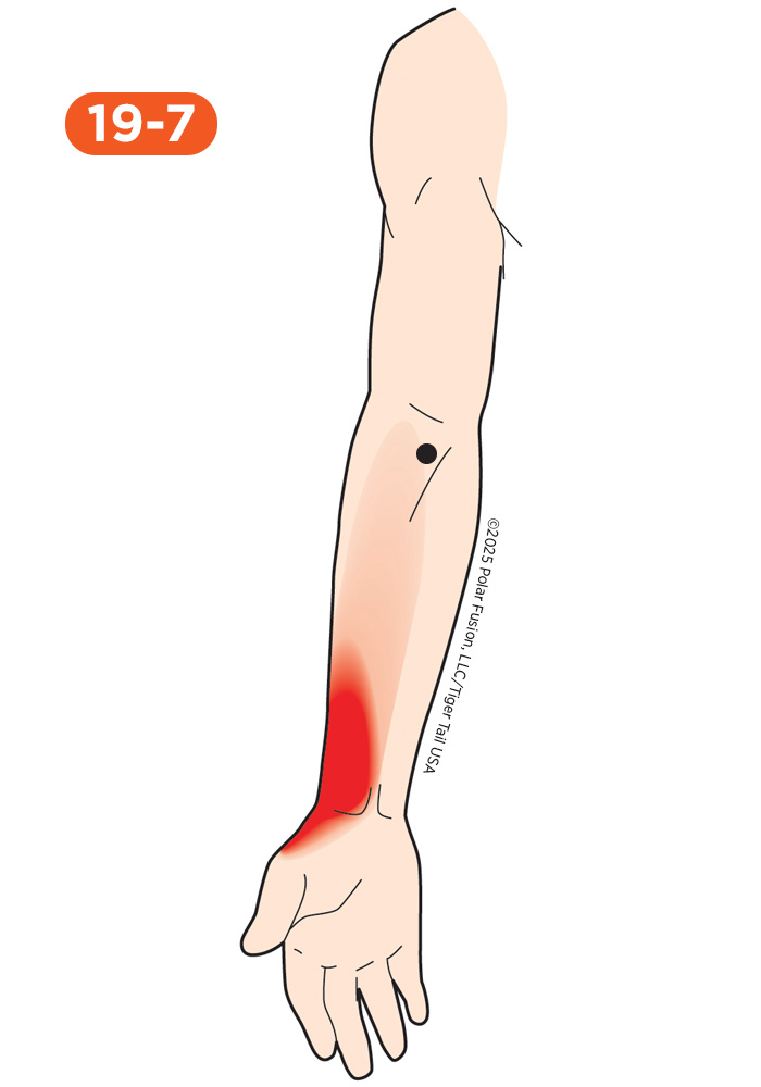 Wrist Pain 19-7 Pronator Teres